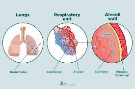 Factors Linked With Increased Risk Of Interstitial Lung Disease In Rheumatoid Arthritis