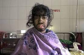 Sixteen kids have reportedly developed werewolf syndrome after taking contaminated or, at least, she has werewolf syndrome, which is a real condition. Babies Contract Werewolf Syndrome From Tainted Formula