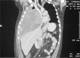 As either epithelioid, sarcomatoid, or mixed/biphasic. Malignant Pleural Sarcomatoid Mesothelioma Surgery