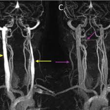 The left and right common carotid arteries ascend up the neck, lateral to the trachea and the oesophagus. Vasculature Of The Head And Neck Arteries And Veins Can Be Visualized Download Scientific Diagram