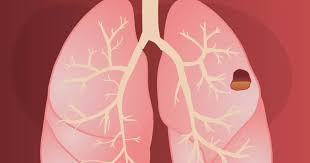 Image result for Lung Abscess