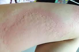 How To Treat Hives Urticaria Allergy Remedies Cold Urticaria