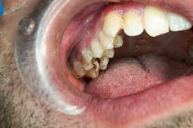 With the right dentists, however, the procedure is painless and fast. Root Canal Pulp Extraction From Molar Stock Image C038 7794 Science Photo Library