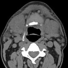 Image result for Sialoadenitis