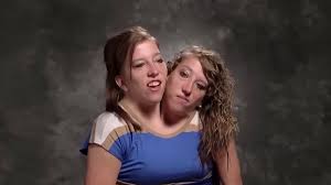La inspiradora vida de las siamesas Abby y Brittany Hensel, una historia  que desafía los límites de la medicina y genera una polémica fascinación  mundial - Infobae