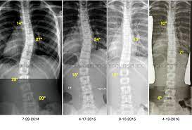 Correct Scoliosis Without Surgery Scoliosis Correction Reduce Scoliosis