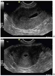 Image result for First Trimester Ultrasound