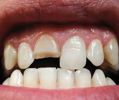 Image result for Tooth Fracture