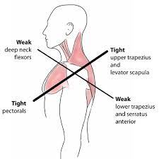 Upper Cross Syndrome Ashworth Chiropractic Acupuncture Clinic