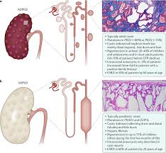 Polycystic Kidney Disease Abstract Europe Pmc
