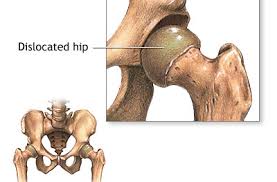 Cancer of the hip bone may also cause fatigue and general lack of energy. Hip Dysplasia Symptoms And Causes
