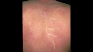 サウナ アトピー