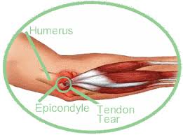 Image result for Elbow Joint Injection