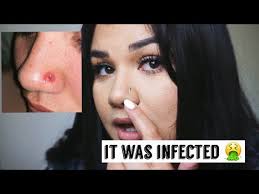 Note that it is quite normal for a properly healing nose piercing to ooze a thin clear fluid; My Infected Nose Piercing How I Healed It Youtube