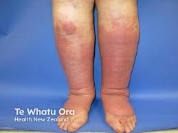 Image result for Lipodermatosclerosis