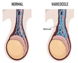 Image result for Varicocele