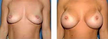 Brustvergrößerung | Bilder vor und nach einer Brustoperation mit  Brustimplantat