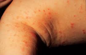 Image result for scabies human bites