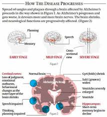 Er richtet sich gegen aggregierte formen von. Latest Research On Fighting Alzheimer S Disease More Trials And Some Error Explained News The Indian Express