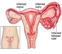 We did not find results for: Pelvic Inflammatory Disease American Pregnancy Association