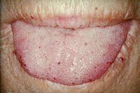 Hereditary Hemorrhagic Telangiectasia Symptoms And Diagnosis
