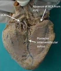 The left atrium (la) has a smooth endocardium while the right atrium (ra) is trabeculated. Posterior View Of The Heart Showing Absence Of Right Coronary Artery Download Scientific Diagram
