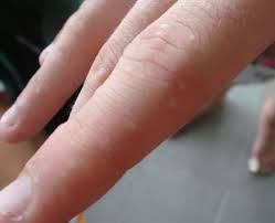 Itchy feet and hands can also be a result of a bite by the dreaded itch mite the main cause of scabies. Dyshidrotic Eczema A Condition In Which Small Itchy Blisters Are Developed On The Feet And Hands Eczema Treatment Eczema Cure Eczema Pictures