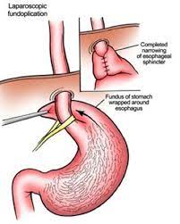 Is that burning sensation in your gut an ulcer or gerd (gastroesophageal reflux disease)? ÙƒÙŠÙ ÙŠØªÙ… Ø¹Ù„Ø§Ø¬ Ù…Ø±Ø¶ Ø§Ø±ØªØ¬Ø§Ø¹ Ø§Ù„Ù…Ø¹Ø¯Ø©