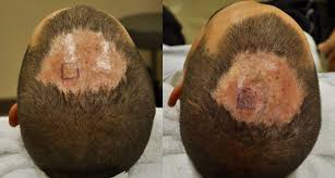 The hair follicles are completely destroyed causing permanent hair loss and tissue scarring under the skin. Fue Hair Transplantation Scar Tissue Following Mrsa Infection Abhrs American Board Of Hair Restoration Surgery