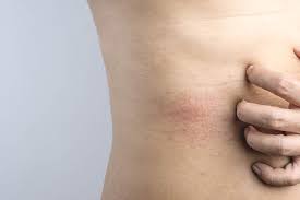 Kaki dan tangan menjadi sejuk dari bahagian badan lain. Ruam Kulit Akibat Hiv Penyebab Gejala Dan Cara Mengatasinya
