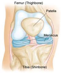 Can a torn meniscus get worse over time. Meniscus Tear Treatment Surgery Providence Orthopaedics