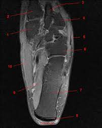 Muscles of the foot muscle origin insertion nerve supply extensor digitorum brevis distal part of the lateral and superior surfaces of the calcaneus and the apex of the inferior extensor retinaculum as the fiber bundles extend distally, they become grouped into four bellies. Mri Of The Ankle Detailed Anatomy W Radiology
