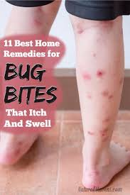 Bug Bites That Get Itchy And Swollen Can Cause A Lot Of Grief Try These Home Remedies To Get Relief You Bug Bites Remedies Remedies Natural Healing Remedies