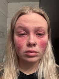 Severe allergy sufferers finding alternatives to zyrtec?