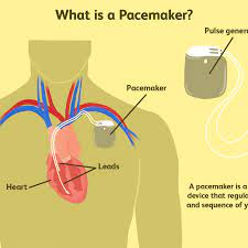 Pacemaker is an open source, high availability resource manager suitable for both small and large clusters. What You Should Know About Pacemakers
