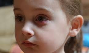 Como Curar Un Orzuelo O Chalazion Remedios Curiosfera Com