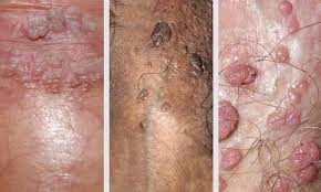 Image result for genital warts