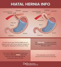 Can a hiatal hernia feel like a heart attack? Hiatal Hernia Symptoms Causes And Natural Support Strategies