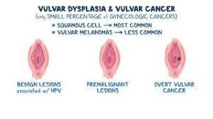 Image result for Vulvar Cancer