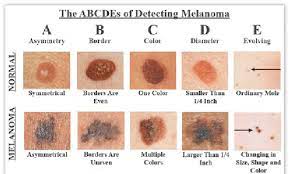 Instead, it groups cancers into localized, regional, and distant stages: How To Detect Melanoma Source The Skin Cancer Foundation Download Scientific Diagram