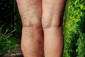 Advantages Of Endovenous Laser Treatment For Varicose Veins Vein Laser Institute
