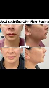 Another delighted client recently underwent jowl sculpting with Plexr  Plasma treatment. Just two weeks after the procedure, she experienced a  remarkable reduction in jowl sagging. This initial ...