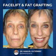 ✨Timeless beauty, naturally restored.✨ We are excited to share the before &  after of our beautiful patient, featuring a facelift with fat grafting—a  powerful combo for facial rejuvenation. 💉 Fat grafting uses