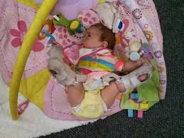 Froggied Princess Our Life With A Wheaton Pavlik Harness Hip Hop 5k Baby Car Seats Hip Hop Hips