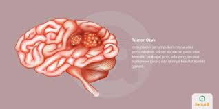 We did not find results for: Tumor Otak Tanda Dan Gejala Penyebab Cara Mengobati Cara Mencegah