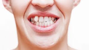 Dente Encavalado Quanto Custa O Tratamento E Quais As Causas