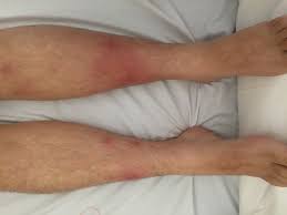 Image result for erythema nodosum