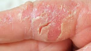 In some cases, neurodermatitis is associated with chronic skin conditions — such as dry skin, eczema or psoriasis. á… Neurodermitis Ursachen Symptome Und Behandlung