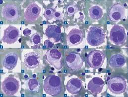 Benign mesothelial cells are known to contain muscle filaments and they express . The Panorama Of Different Faces Of Mesothelial Cells Basicmedical Key