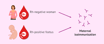 Image result for Rh Sensitization
